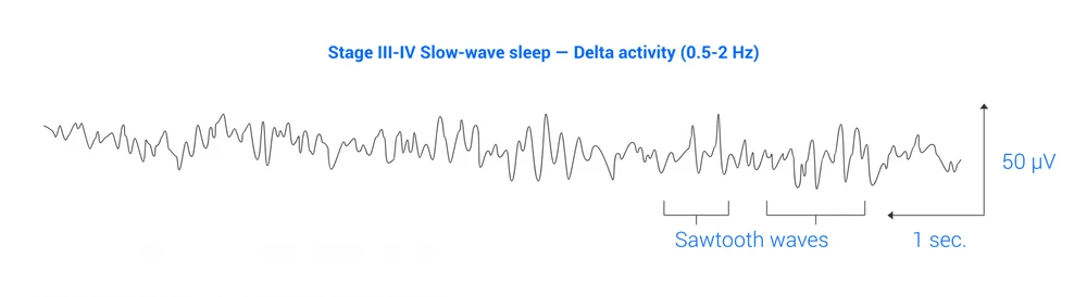 Trazado EEG que muestra la fase III-IV de sue&ntilde;o de ondas lentas y ondas en diente de sierra.