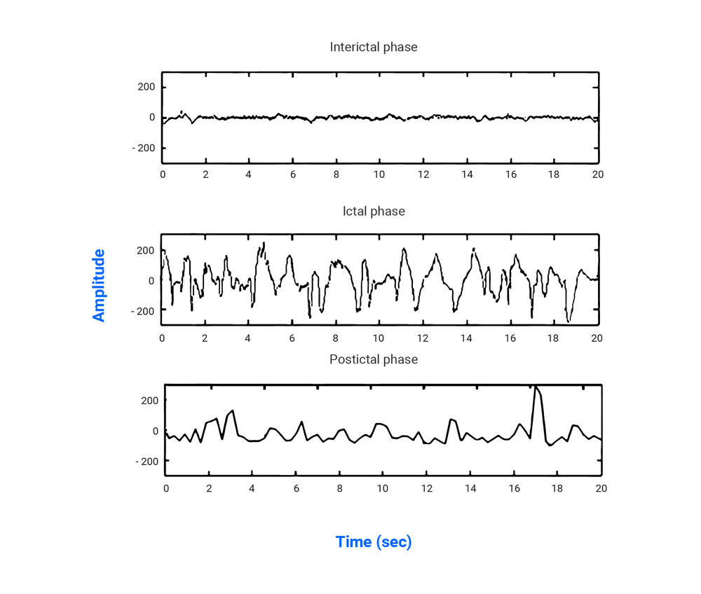 Epilepsy and EEG Seizuredetection Bitbrain