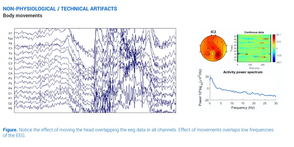 Eeg Artifact Body Movements