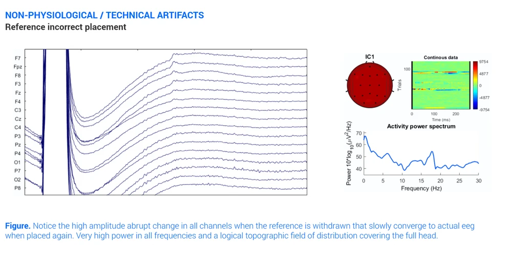 Eeg Reference Bad Placement