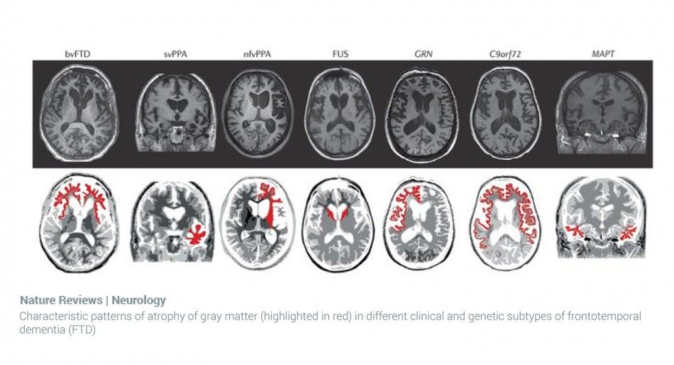 Nature Reviews Atrophy Dementia