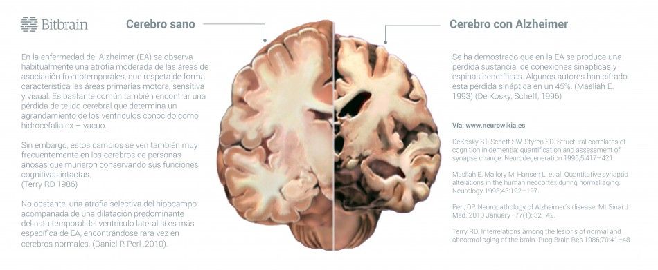 infografia de un cerebro sano y un cerebro con la demencia del alzheimer que sufre un deterioro cognitivo en personas que no hace estimulacion cognitiva para entrenar el cerebro