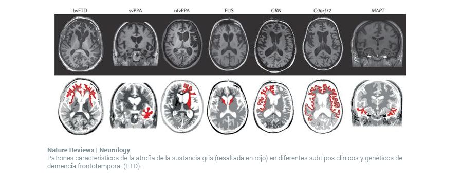 cerebro con demencia que sufre un deterioro cognitivo por no haber hecho entrenamiento del cerebro con estimulación cognitiva de neurotecnología