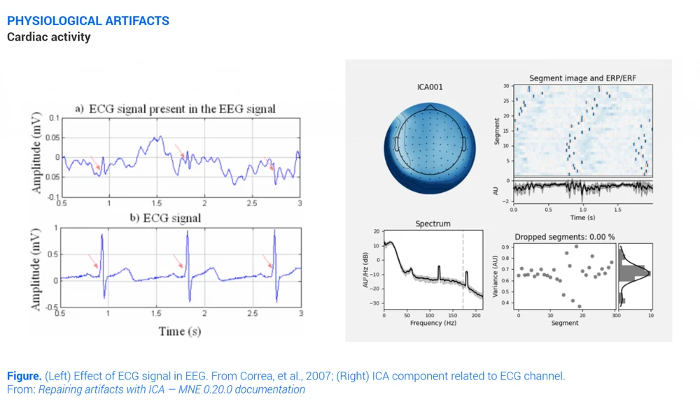 Cardiac Activity Eeg Artifact