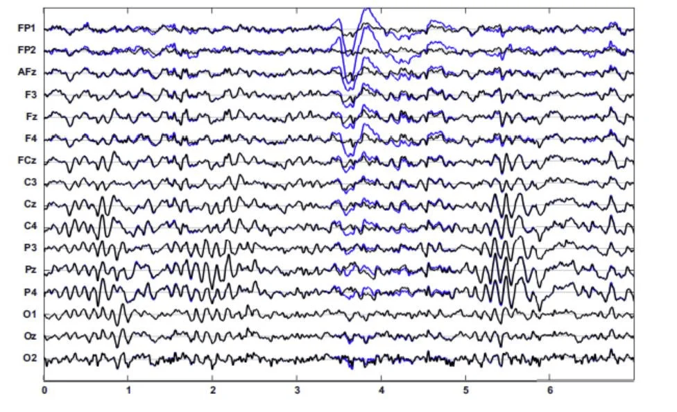 Eeg Artifacts