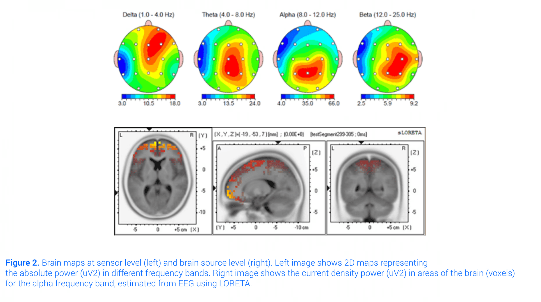 Imágenes de localización de fuentes cerebrales estimadas a partir de registros EEG, mostrando la distribución de la actividad neuronal en diferentes regiones del cerebro.
