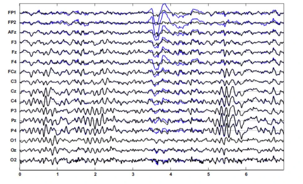 Eeg Artifacts