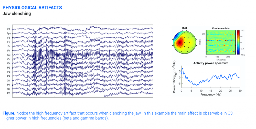 Jaw Clenching Eeg Artifact