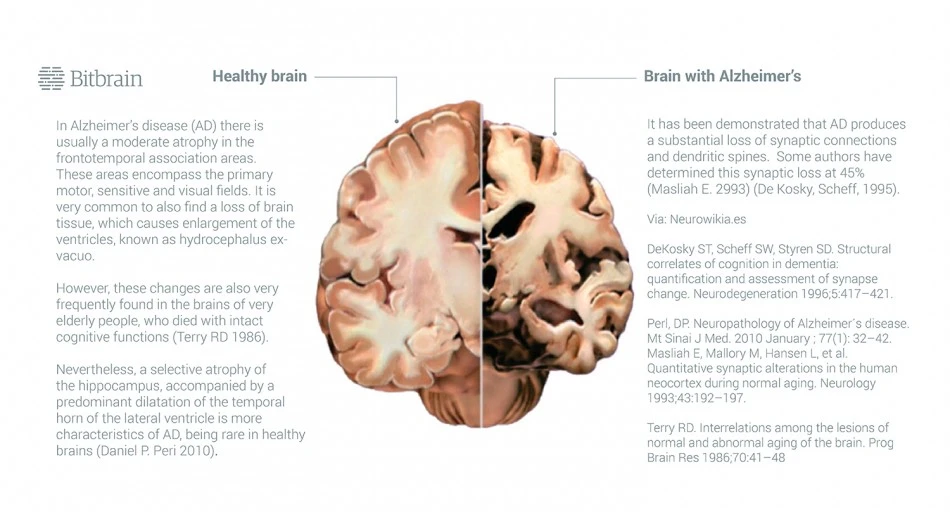 brain with cognitive impairment in older people who have not done cognitive stimulation with neurofeedback