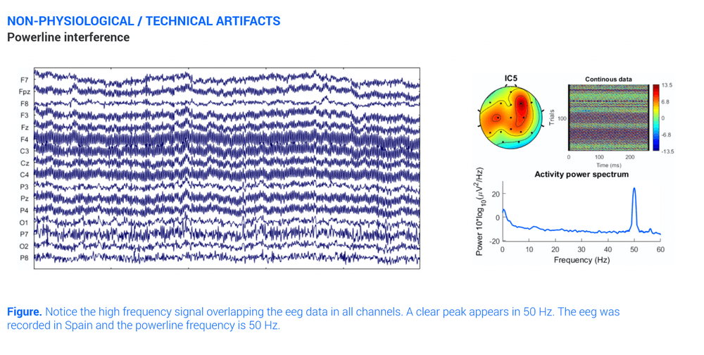 Ac Interference Eeg Artifact