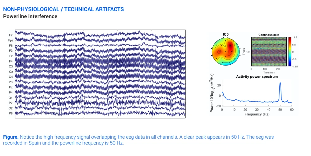 Ac Interference Eeg Artifact