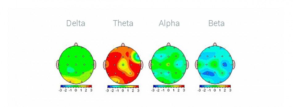 mapa de cerebro o brain mapping de un QEEG hecho con un EEG y neurotecnología para ver las diferencias de señal cerebral de los niños con TDAH hiperactividad e inatención